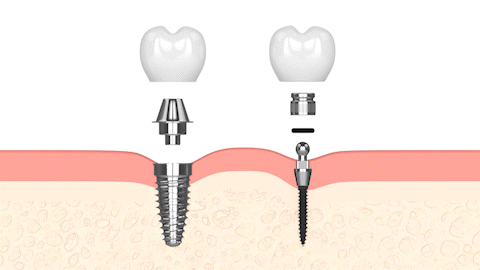 ClearChoice en Lake City, FL | Mini Implantes Dentales | Dientes Nuevos